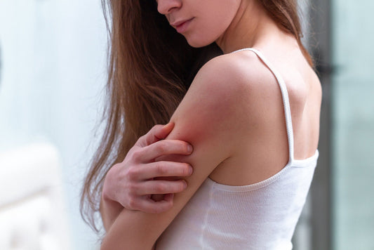 A woman scratches eczema on her arm. Organic eczema lotion can have many powerful impacts on managing the itchy irritation of eczema. Learn more in our complete guide.